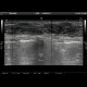 Endometriosis of the abdominal wall: US - Ultrasound